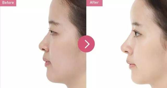 2023年天津太陽穴填充醫(yī)院排行榜出爐，這些醫(yī)院專業(yè)可靠！