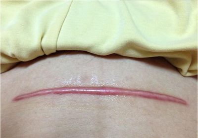 注射玻尿酸去褶皺前需要注意的事項(xiàng)有哪些？