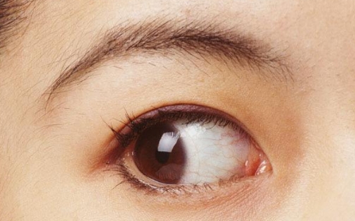 什么牌子的玻尿酸最適合成都隆鼻手術(shù)？