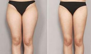 西安做自體豐胸哪家好？揭秘西安自體豐胸神奇醫(yī)院