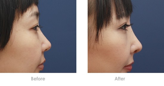 西京易成剛隆胸效果如何？西京易成剛隆胸的醫(yī)生有哪些？技術(shù)和口碑怎么樣？收費(fèi)明細(xì)表是怎樣的呢？