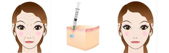 玻尿酸瘦臉，瘦臉神器是什么？
