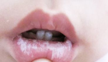 合肥疤痕治療哪家醫(yī)院好？專家推薦，無痛治療快速療效明顯