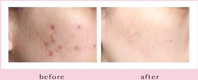 硅膠隆鼻有哪些影響價(jià)格的因素？