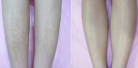 成都眼綜合手術哪家醫(yī)院好？綜合手術方案推薦及術后效果對比