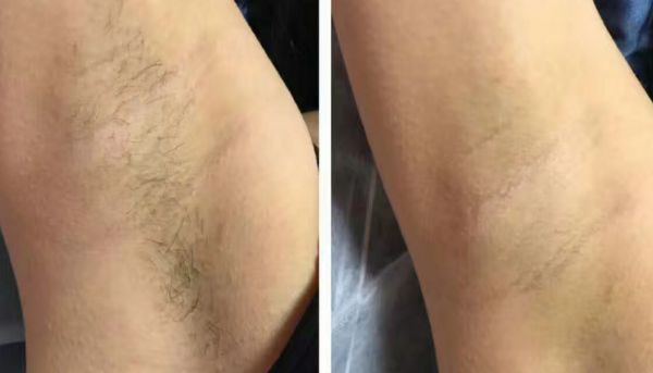 【2023年北京哪家醫(yī)院去痘坑好？專家推薦最適合你的選擇！】