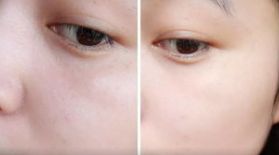 杭州去除痘坑哪家醫(yī)院好？選擇杭州專業(yè)去痘坑醫(yī)院的幾個(gè)關(guān)鍵點(diǎn)