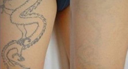 廣州哪家醫(yī)院做雙眼皮效果好，推薦一家專業(yè)整形醫(yī)院