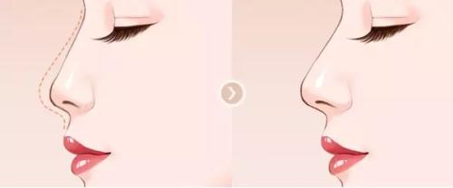 年齡不再是面部提拉緊致的唯一方法，你知道為什么嗎？毛孔系數(shù)也能幫忙！