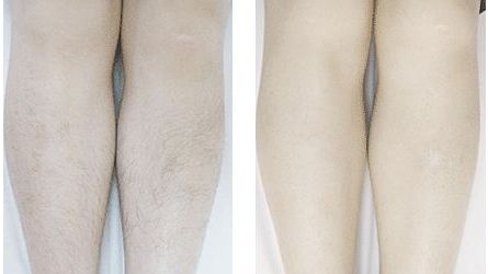 大連哪家醫(yī)院做酒窩好？選擇優(yōu)質(zhì)醫(yī)院打造完美酒窩的專(zhuān)業(yè)技巧詳解