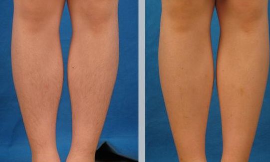 保定光子嫩膚哪家好？教你如何選擇適合你的醫(yī)院