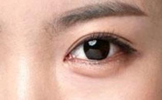 如何改善紅血絲問(wèn)題，價(jià)格是否有影響？