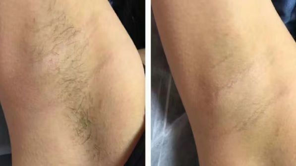 廊坊哪家雙眼皮整形醫(yī)院口碑好，專業(yè)雙眼皮割眼部效果好？