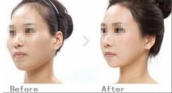 黑臉娃娃到底有何療效？一個(gè)療程費(fèi)用大約多少？