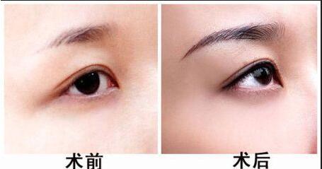 臥蠶、淚溝與眼袋有何不同？正確了解能有效解決嗎？