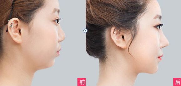 昆明達拉斯隆鼻效果如何？哪家醫(yī)美機構(gòu)靠譜？