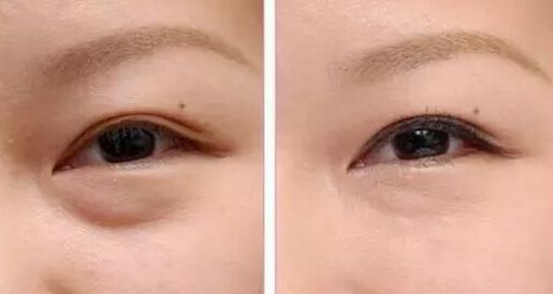 柳州市哪家醫(yī)院祛斑效果好？柳州市民推薦的專業(yè)祛斑醫(yī)院大揭秘！