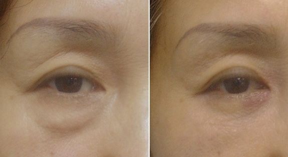 西安雙眼皮手術(shù)哪家醫(yī)院靠譜又實(shí)惠？