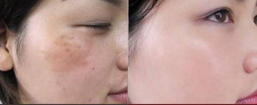 《常州看痘印醫(yī)院排名及患者口碑調(diào)查，哪家好？》