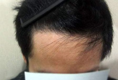 武漢果酸換膚：10家醫(yī)院推薦，美白效果最佳排名！