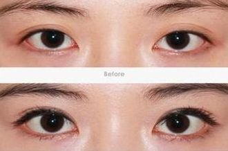 合肥隆鼻修復哪家醫(yī)院好？專業(yè)醫(yī)院排行榜及術后效果對比！