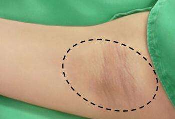芭比款是適合哪種眼型的？知道雙眼皮手術(shù)的價格嗎？