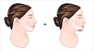 什么樣的人適合光子嫩膚去黑眼圈術(shù)？注意事項(xiàng)是什么？