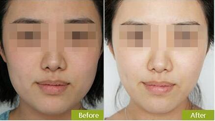 長了很多密密麻麻的小痘痘是什么原因？壞習慣曝光！