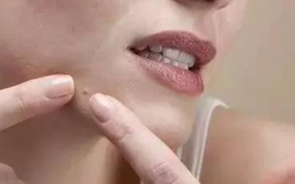 該怎樣去除下巴多余脂肪？選擇抽脂還是溶脂美容？