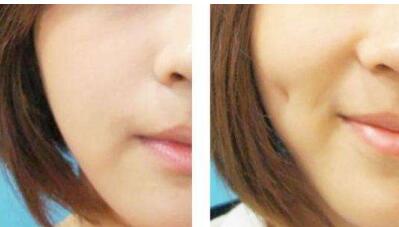 整牙齒的費(fèi)用如何？整牙過(guò)程有哪些注意事項(xiàng)？