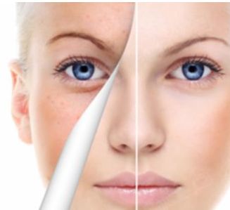 南寧哪家醫(yī)院專(zhuān)業(yè)治療胎記效果好？