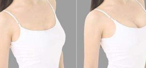 面部提升術(shù)后有哪些遺癥？玲鐺線和傳統(tǒng)式蛋白線提升的差別是什么？