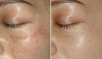 石家莊激光祛斑哪家靠譜？一文帶你選擇最好的祛斑機構！