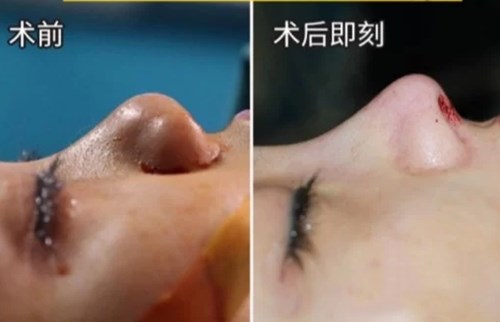 為什么外眼角手術(shù)后不留疤痕，如何進行護理？