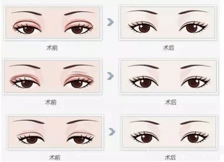 廣州臀部整形醫(yī)院推薦排名及評價解析 廣州臀部整形醫(yī)院推薦排名及評價解析