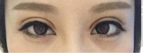 懷化哪家醫(yī)院適合開(kāi)眼角手術(shù)？開(kāi)眼角手術(shù)如何選擇醫(yī)院