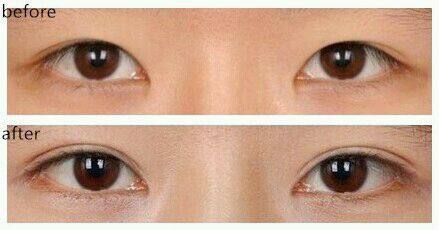 哪家寧波整形醫(yī)院在2023年排名前十，面部下垂提升效果好？