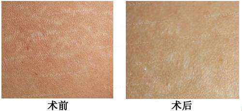 玻尿酸豐臉頰是否會(huì)引發(fā)副作用？?jī)r(jià)格一般多少？