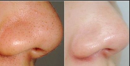 浙江隆胸手術(shù)哪家醫(yī)院好？浙江隆胸手術(shù)醫(yī)院排名及選擇技巧解析