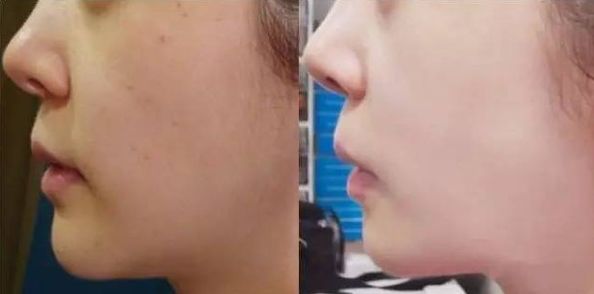 天津激光祛痘哪家醫(yī)院好？全面評估天津?qū)I(yè)激光祛痘醫(yī)院的優(yōu)勢