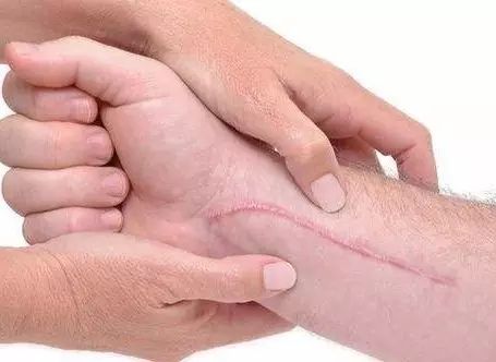 鼻唇溝填充哪種材料最適合？選用方法有哪些？