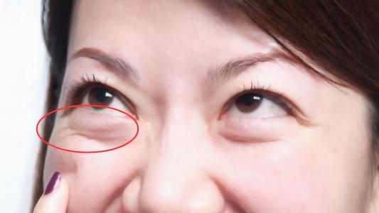 激光祛痘祛斑術(shù)后注意事項(xiàng)：價(jià)格區(qū)間是多少？