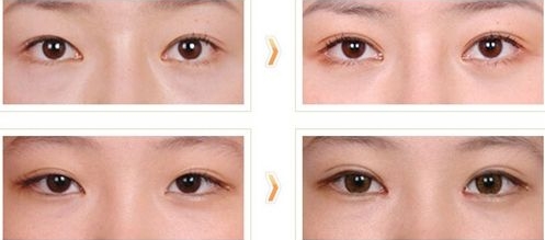 東營(yíng)膠原蛋白祛魚(yú)尾紋的權(quán)威醫(yī)院推薦