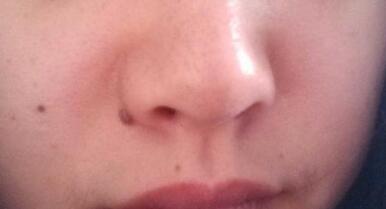 隆鼻后遺癥多少種？“骨粉”隆鼻真的靠譜嗎？