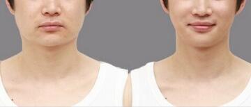 隆胸手術(shù)后是否可正常哺乳？是否會對哺乳產(chǎn)生影響？