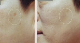 深圳哪家醫(yī)院的雙眼皮手術(shù)效果最佳？