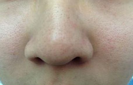 寧波哪家醫(yī)院的祛黃褐斑效果好且受到用戶好評(píng)？