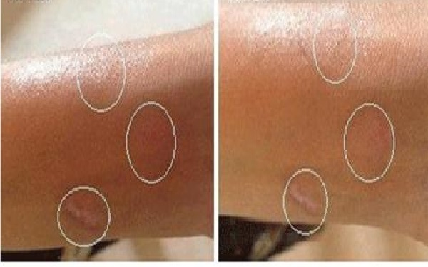 妙桃琴面豐胸假體的獨特之處是什么？效果如何？使用注意事項有哪些