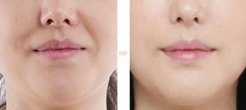 【2023佛山做雙眼皮哪家醫(yī)院好？從專業(yè)技術(shù)到精細(xì)服務(wù)全面解析】