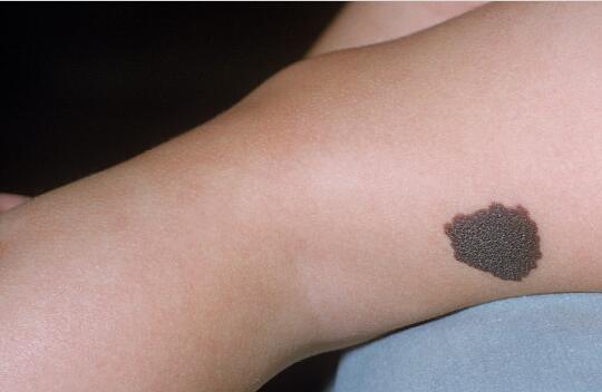 果酸換膚一個療程需要花費多少錢？術(shù)后需要注意哪些事項？